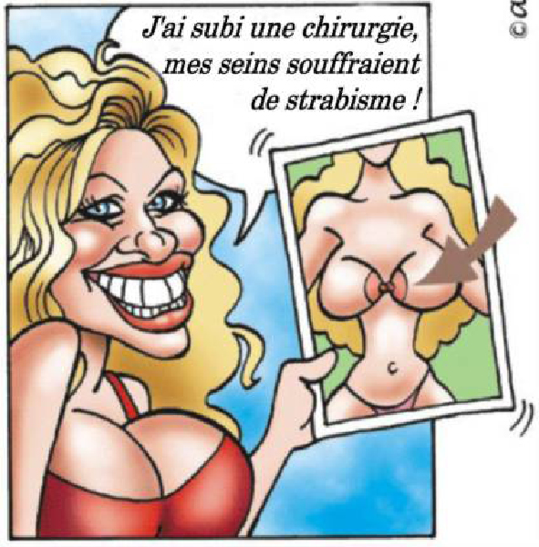 strabisme-HeV